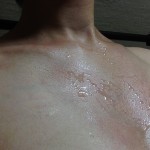 【アレルギー症状を出さないための化粧水の塗り方のコツ】うっかり日焼け・・その後。